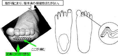 足のアーチの構造(内側縦アーチ・外側縦アーチ・横アーチ)