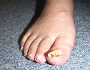 巻き爪になりやすい人