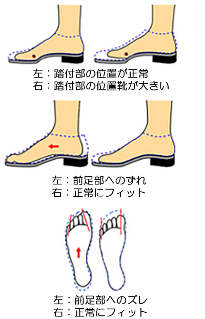 靴のサイズ：足に合わない靴の例