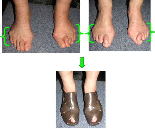 内反小趾と靴選び