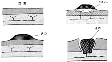 足裏のタコと魚の目の違い